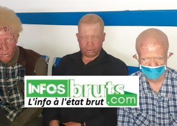 Kindia : Les albinos tirent le diable par la queue, en cette période de Covid-19